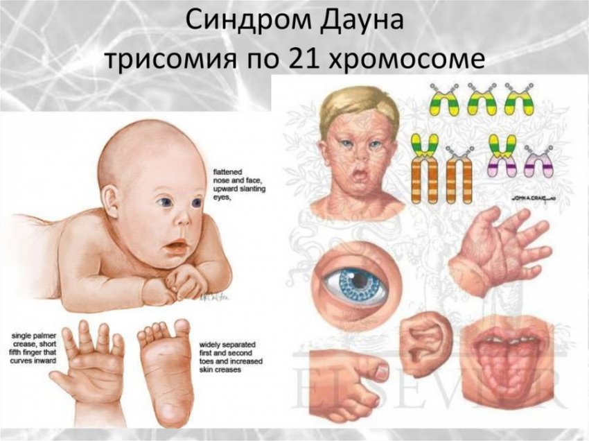 Обнаружен ген, с помощью которого изобретут лекарство от синдрома Дауна