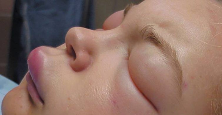 Тюменские медики отказали в первой помощи пациентке с отеком Квинке