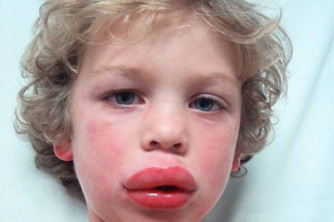 Тюменские медики отказали в первой помощи пациентке с отеком Квинке Тюменские медики отказали в первой помощи пациентке с отеком Квинке