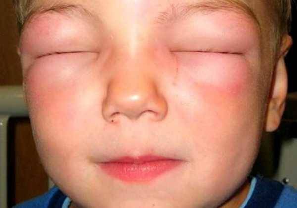 Тюменские медики отказали в первой помощи пациентке с отеком Квинке Тюменские медики отказали в первой помощи пациентке с отеком Квинке