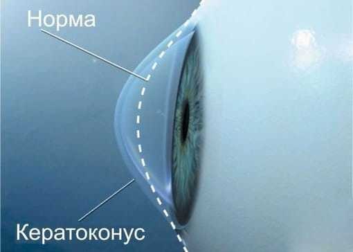 Астигматизм у детей лечится или нет: 5 способов лечения
