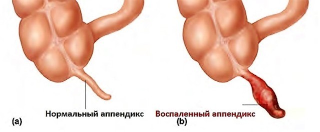 Симптомы аппендицита у детей: 8 основных и 9 дополнительных признаков, срочные действия