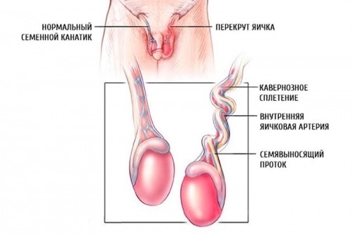 Синдром острой мошонки у мальчиков: 7 острых заболеваний, лечение и советы врача родителям