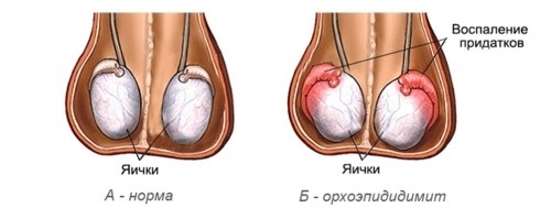 Синдром острой мошонки у мальчиков: 7 острых заболеваний, лечение и советы врача родителям