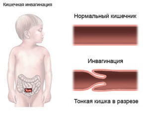 Инвагинация кишечника у детей: 3 основных симптома, 4 причины, способы лечения, видео