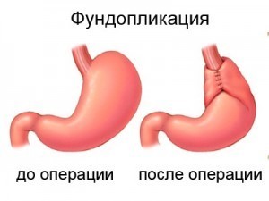 Изжога у детей: 8 причин, 10 симптомов, 13 способов лечения, 5 советов врача Изжога у детей: 8 причин, 10 симптомов, 13 способов лечения, 5 советов врача