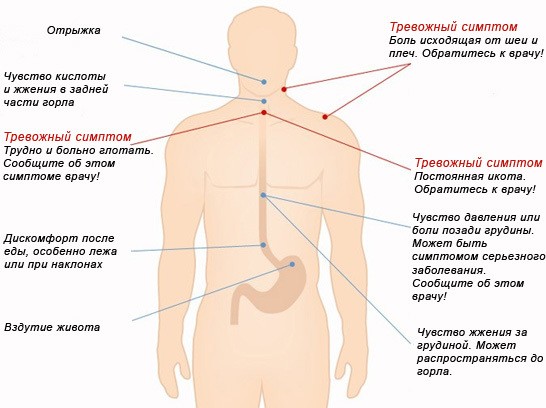 Изжога у детей: 8 причин, 10 симптомов, 13 способов лечения, 5 советов врача Изжога у детей: 8 причин, 10 симптомов, 13 способов лечения, 5 советов врача