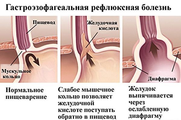 Изжога у детей: 8 причин, 10 симптомов, 13 способов лечения, 5 советов врача Изжога у детей: 8 причин, 10 симптомов, 13 способов лечения, 5 советов врача