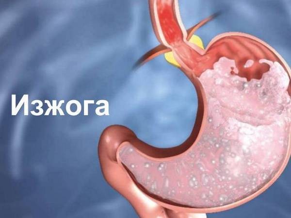 Изжога у детей: 8 причин, 10 симптомов, 13 способов лечения, 5 советов врача Изжога у детей: 8 причин, 10 симптомов, 13 способов лечения, 5 советов врача
